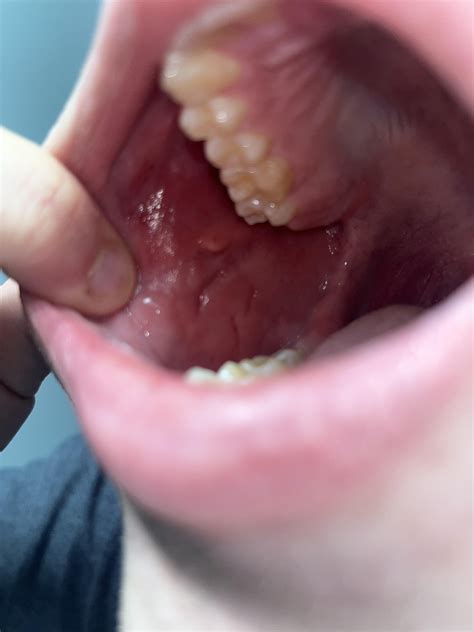 Did I severely bite my cheek? : r/askdentists