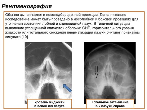 Острые синуситы - презентация онлайн