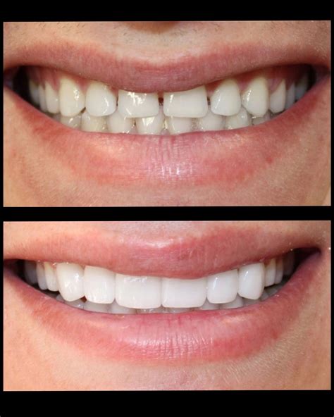 Smile Makeover Gallery - Bayfront Dentistry