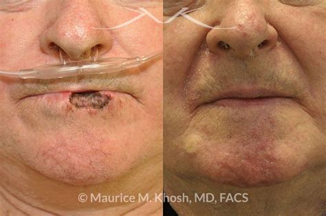 Before And After Mohs Surgery Upper Lip - Infoupdate.org