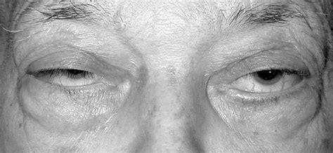 Chronic Lymphocytic Leukemia of the Orbit | JAMA Ophthalmology | JAMA ...