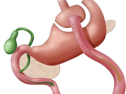 Roux-en-Y or One-Anastomosis Gastric Bypass: Which Is the Better Bariatric Treatment?