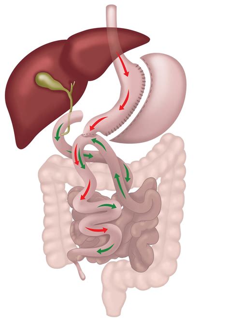SADI-S (SIPS) – WA Weight Loss Centre