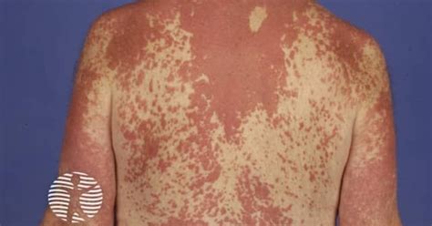 Interstitial granulomatous dermatitis image