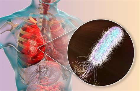 Pseudomonas Infections: Symptoms, Prevention, and Insights