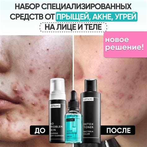 Набор уходовый для лица и тела от прыщей и акне - купить с доставкой по ...