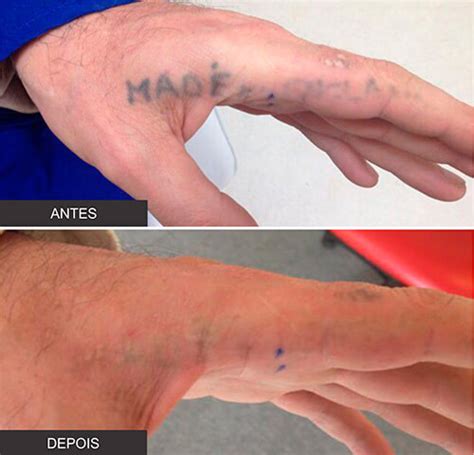 Como Saber Se A Tatuagem Cicatrizou - Cicatriz De Tatuagem Antes E Depois