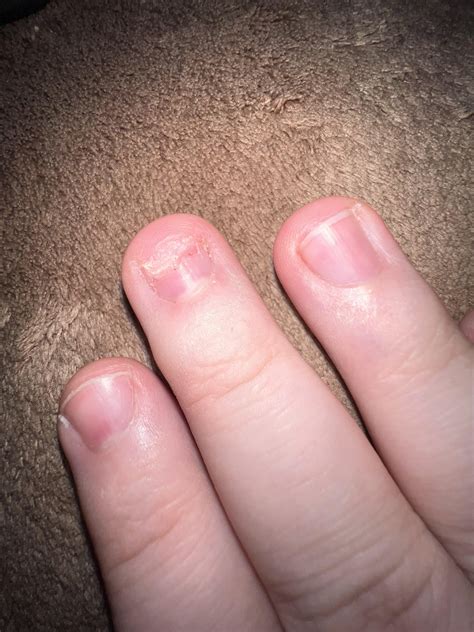 How do I repair my damaged fingernail? It was closed in a car door as a