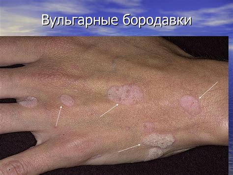 Вирус папилломы человека - презентация онлайн