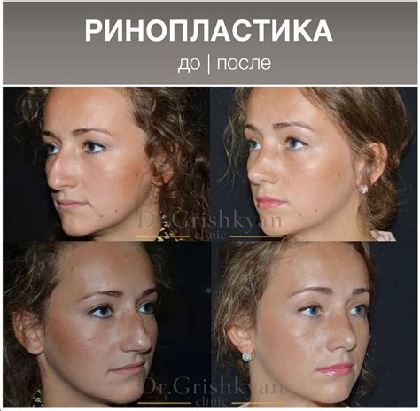 Ринопластика До и После