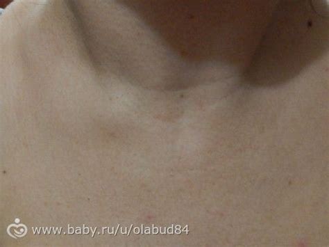 Шишка появилась в области ключицы