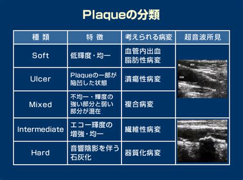 頚動脈超音波検査の有用性 10 ｜ 岡山第一病院