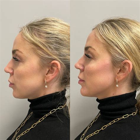 Does Filler In Marionette Lines Lift Jowls? - mag-noor.com