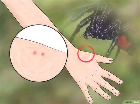 Como Fica A Picada De Aranha - Como Identificar uma Picada de Aranha: 7 Passos