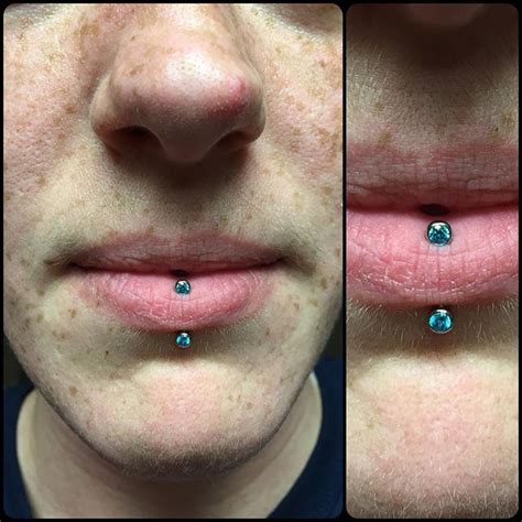 Vertical Labret Piercing Scar