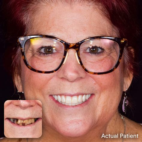 Dental Implants in Charleston SC | Doctors Implants