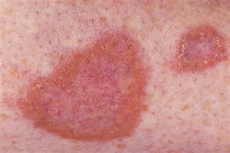 diabetic rashes - pictures, photos
