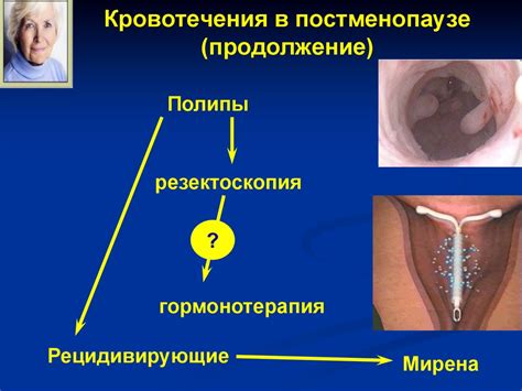 Дисфункциональные маточные кровотечения. Диагноз исключения ...