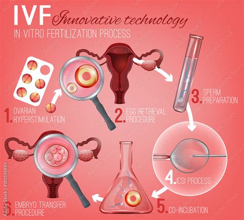 In Vitro Fertilization Stock Vector | Adobe Stock