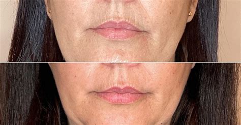 Preenchimento Codigo De Barras Antes E Depois