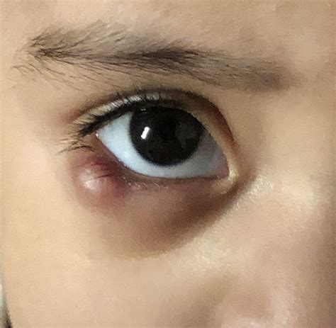 Ask a Pediatrician Online for Eye Stye Or Pimple