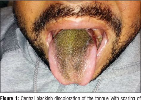 Figure 1 from Medical quiz: Lingua villosa nigra (black hairy tongue ...