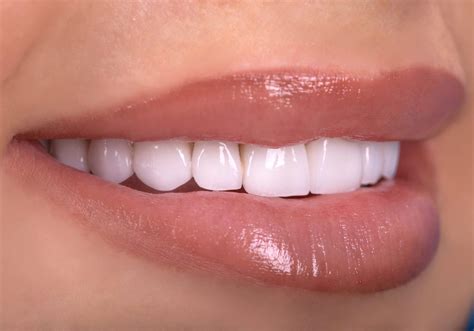 Carillas dentales en Granada - Doctores Valencia