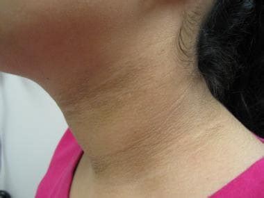 Acanthosis Nigricans Clinical Presentation: History, Physical ...