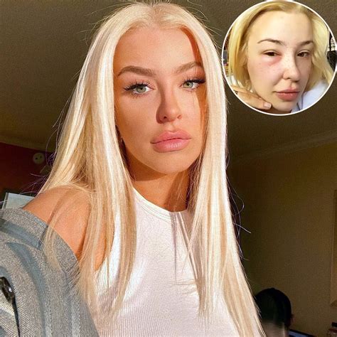 Tana Mongeau Posts Throwback Pics While Suffering From a Swollen Eye