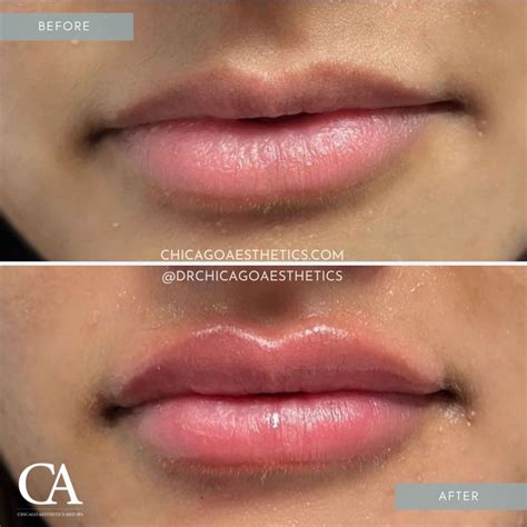 Lip Injections Before After | Chicago Aesthetics Med Spa