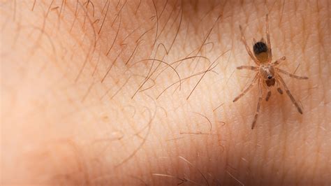 spider bites pictures  symptoms
