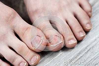 Ugly Toes Of A Girl With A Fungus And Ingrown Toenails Stock Photo ...