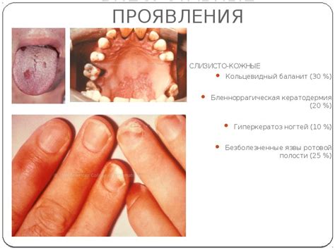 Реактивный артрит - презентация, доклад, проект скачать