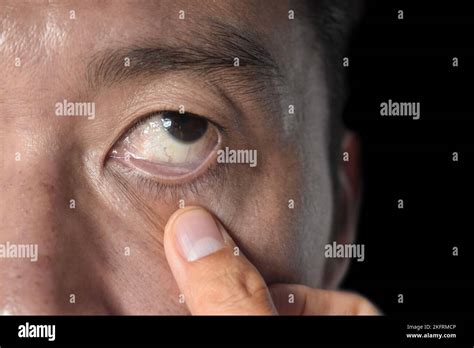Anemia eye hi-res stock photography and images - Alamy