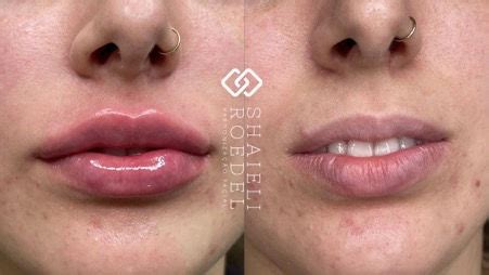 Gravida Pode Fazer Preenchimento Labial - Preenchimento labial antes e depois, veja transformações.
