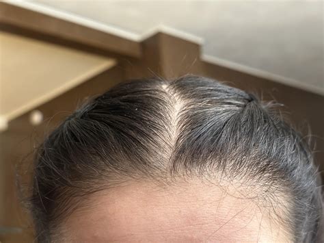 Do these hairs look like regrowth? : r/FemaleHairLoss