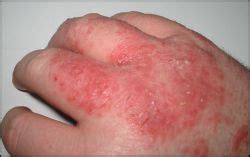 eczema wikidoc