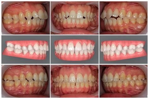 Aligners For Bruxism at Jerry Demelo blog