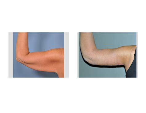 armlift-after-extreme-weight-loss-dr-barry-eppley-indianapolis