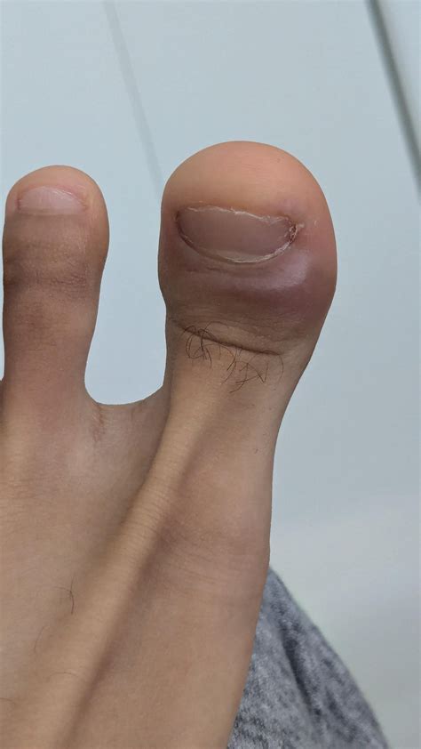 Left big toe has been starting to worry me. Is it broken? : r/medical