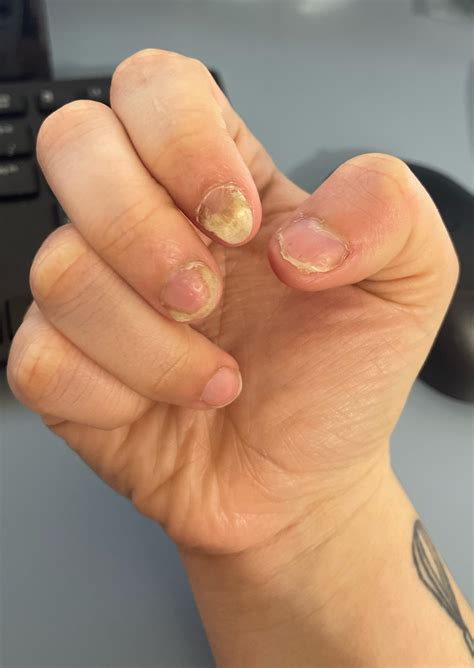 Psoriasis in only the nails? Details in comments. : r/Psoriasis
