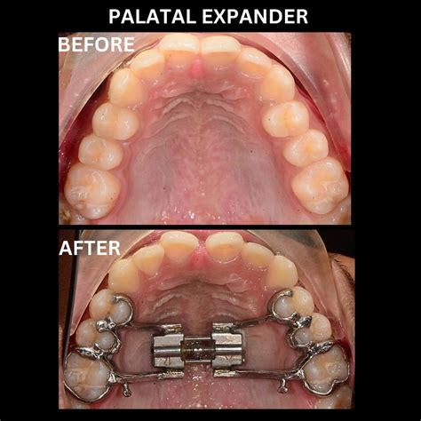 types  braces  teeth explore  options   perfect