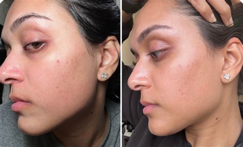 micro infusion device