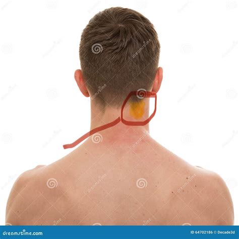 Pain in the right side of my neck : r/DiagnoseMe