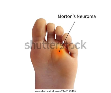 52 Foot Mortons Neuroma Images, Stock Photos & Vectors | Shutterstock