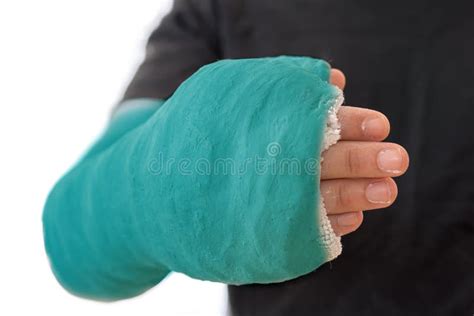 Close Up of a Long Arm Cast Stock Image - Image of cyan, elbow: 82120287
