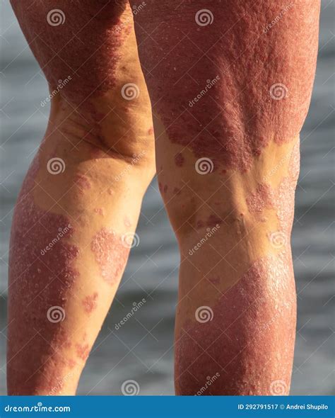 Red Spots on the Legs of a Person. Stock Image - Image of sore