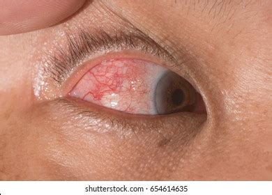 3+ Hundred Episcleritis Royalty-Free Images, Stock Photos & Pictures ...