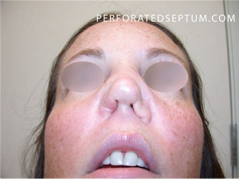 Perforated Septum, Dr. Hamilton - Surgical Repair of a Hole in the Septum
