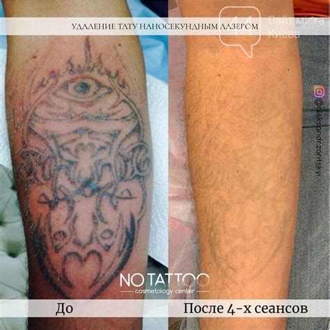 Лазерное удаление тату и татуажа наносекундным и пикосекундным лазерам ...